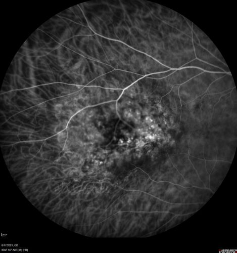 Choroidal Hemangioma Requiring PDT repeatedly
64 year old man.  Diagnosed with hemangioma in 2015.  PDT in 2016.  Images are from 2020 when fluid started to reaccumulate.  Needed PDT repeated two more times.
PDT treatments: [1] 2/19/2015 -Â  Pavan (IOPÂ  problem after PDT)Â  AND [2] 11/2/21 PDT (7 mm temporal to fovea) - SMCÂ  AND [3] 7/22/22 PDT 7.5 mm Temporal to the fovea
