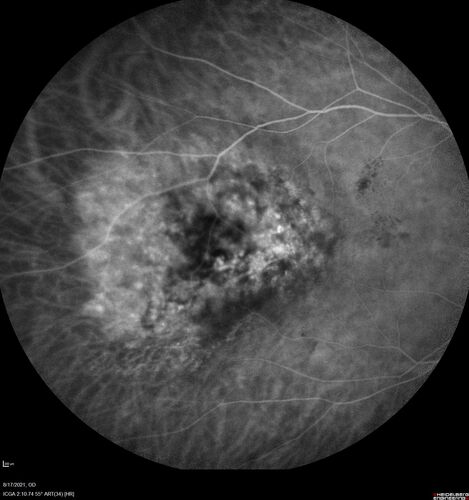 Choroidal Hemangioma Requiring PDT repeatedly
64 year old man.  Diagnosed with hemangioma in 2015.  PDT in 2016.  Images are from 2020 when fluid started to reaccumulate.  Needed PDT repeated two more times.
PDT treatments: [1] 2/19/2015 -Â  Pavan (IOPÂ  problem after PDT)Â  AND [2] 11/2/21 PDT (7 mm temporal to fovea) - SMCÂ  AND [3] 7/22/22 PDT 7.5 mm Temporal to the fovea
