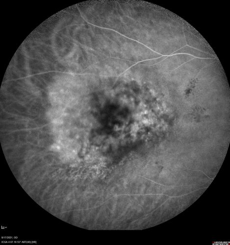 Choroidal Hemangioma Requiring PDT repeatedly
64 year old man.  Diagnosed with hemangioma in 2015.  PDT in 2016.  Images are from 2020 when fluid started to reaccumulate.  Needed PDT repeated two more times.
PDT treatments: [1] 2/19/2015 -Â  Pavan (IOPÂ  problem after PDT)Â  AND [2] 11/2/21 PDT (7 mm temporal to fovea) - SMCÂ  AND [3] 7/22/22 PDT 7.5 mm Temporal to the fovea
