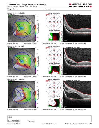 Choroidal Hemangioma Requiring PDT repeatedly
64 year old man.  Diagnosed with hemangioma in 2015.  PDT in 2016.  Images are from 2020 when fluid started to reaccumulate.  Needed PDT repeated two more times.
PDT treatments: [1] 2/19/2015 -Â  Pavan (IOPÂ  problem after PDT)Â  AND [2] 11/2/21 PDT (7 mm temporal to fovea) - SMCÂ  AND [3] 7/22/22 PDT 7.5 mm Temporal to the fovea
