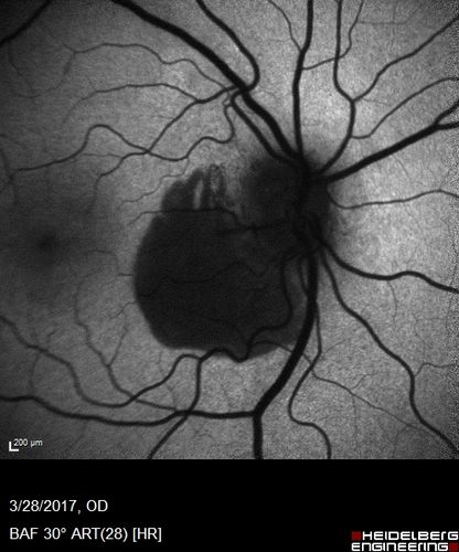 Subretinal Hemorrhage - Commotio Retinae - Macula - hit with baseball
15 year old with VA 20/60 3 days after being hit with baseball in the right eye
