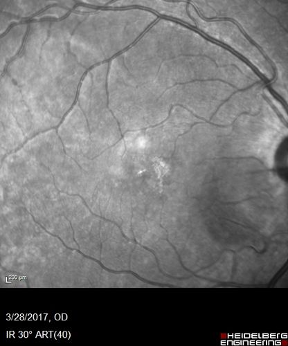 Subretinal Hemorrhage - Commotio Retinae - Macula - hit with baseball
15 year old with VA 20/60 3 days after being hit with baseball in the right eye
