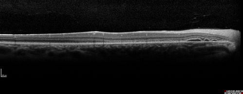 Subretinal Hemorrhage - Commotio Retinae - Macula - hit with baseball
15 year old with VA 20/60 3 days after being hit with baseball in the right eye
