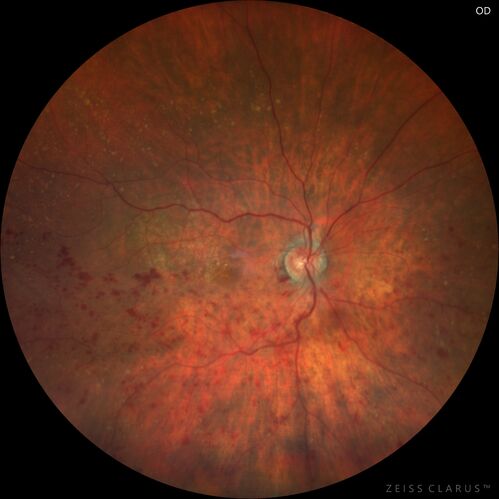 Hemi-CRVO - dual trunk vein
81 year old female mild vision loss - Anatomy shows dual trunk vein with one blocked.  About 20 percent of people have this anatomy
