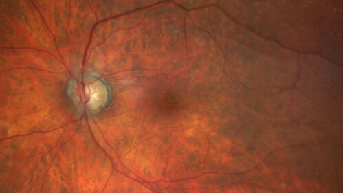 Hemi-CRVO - dual trunk vein
81 year old female mild vision loss - Anatomy shows dual trunk vein with one blocked.  About 20 percent of people have this anatomy
