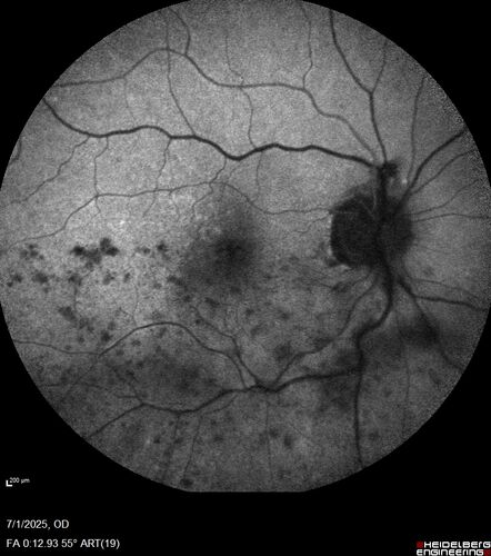 Hemi-CRVO - dual trunk vein
81 year old female mild vision loss - Anatomy shows dual trunk vein with one blocked.  About 20 percent of people have this anatomy
