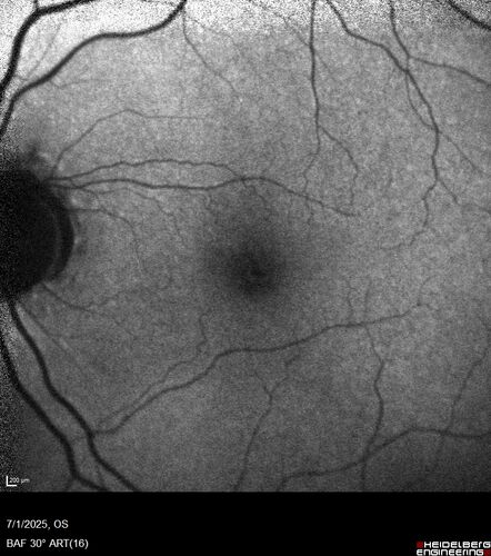 Hemi-CRVO - dual trunk vein
81 year old female mild vision loss - Anatomy shows dual trunk vein with one blocked.  About 20 percent of people have this anatomy
