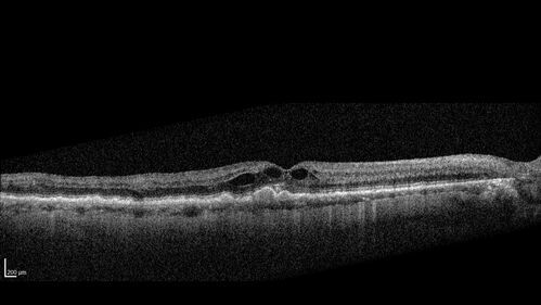 Hemi-CRVO - dual trunk vein
81 year old female mild vision loss - Anatomy shows dual trunk vein with one blocked.  About 20 percent of people have this anatomy
