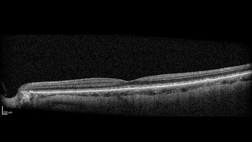 Hemi-CRVO - dual trunk vein
81 year old female mild vision loss - Anatomy shows dual trunk vein with one blocked.  About 20 percent of people have this anatomy
