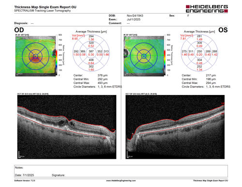 Hemi-CRVO - dual trunk vein
81 year old female mild vision loss - Anatomy shows dual trunk vein with one blocked.  About 20 percent of people have this anatomy
