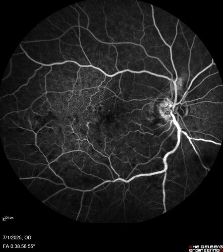 Hemi-CRVO - dual trunk vein
81 year old female mild vision loss - Anatomy shows dual trunk vein with one blocked.  About 20 percent of people have this anatomy
