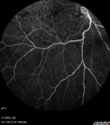 Hemi-CRVO - dual trunk vein
81 year old female mild vision loss - Anatomy shows dual trunk vein with one blocked.  About 20 percent of people have this anatomy
