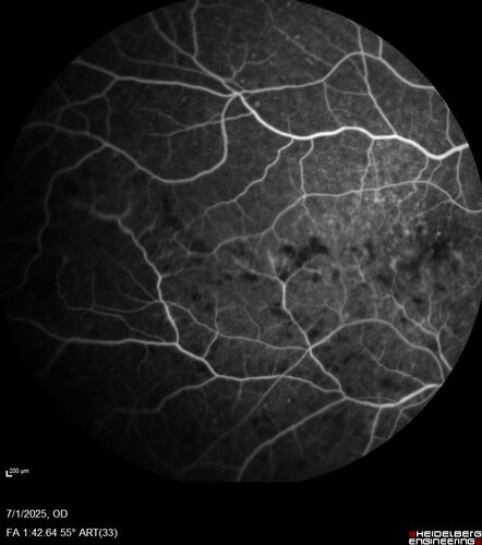 Hemi-CRVO - dual trunk vein
81 year old female mild vision loss - Anatomy shows dual trunk vein with one blocked.  About 20 percent of people have this anatomy
