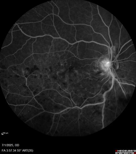 Hemi-CRVO - dual trunk vein
81 year old female mild vision loss - Anatomy shows dual trunk vein with one blocked.  About 20 percent of people have this anatomy
