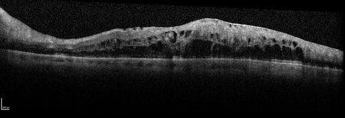 Hemicentral Vein Occlusion Left Eye
Vision improved from 20/100 - 2 to 20/32 with 5 monthly Avastin treatments.
