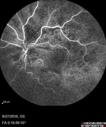 Hemicentral Vein Occlusion Left Eye
Vision improved from 20/100 - 2 to 20/32 with 5 monthly Avastin treatments.
