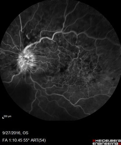 Hemicentral Vein Occlusion Left Eye
Vision improved from 20/100 - 2 to 20/32 with 5 monthly Avastin treatments.
