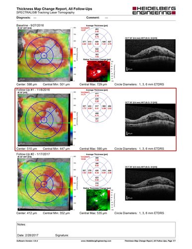 Hemicentral Vein Occlusion Left Eye
Vision improved from 20/100 - 2 to 20/32 with 5 monthly Avastin treatments.
