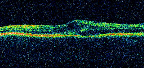 Hemicentral Retinal Vein Occlusion Vision 20/60 
84-year-old man has a hemicentral retinal vein occlusion in the right eye.  His vision has declined since then. 

VISUAL ACUITY:  Vision OD is 20/60.
