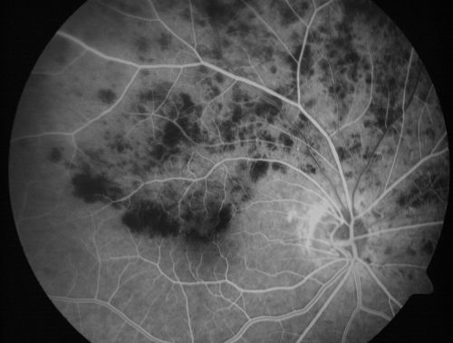 Hemicentral Retinal Vein Occlusion Vision 20/60 
84-year-old man has a hemicentral retinal vein occlusion in the right eye.  His vision has declined since then. 

VISUAL ACUITY:  Vision OD is 20/60.

