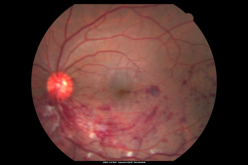 Hemi Central Retinal Vein Occlusion 35 year old non-compliant man
35-year-old man hazy vision in his left eye for about the last three days. OD 20/20,  OS 20/30
