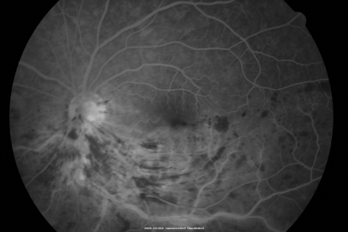 Hemi Central Retinal Vein Occlusion 35 year old non-compliant man
35-year-old man hazy vision in his left eye for about the last three days. OD 20/20,  OS 20/30
