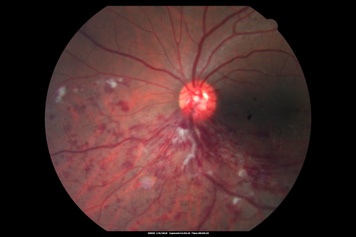 Hemi Central Retinal Vein Occlusion 35 year old non-compliant man
35-year-old man hazy vision in his left eye for about the last three days. OD 20/20,  OS 20/30
