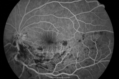 Hemi Central Retinal Vein Occlusion 35 year old non-compliant man
35-year-old man hazy vision in his left eye for about the last three days. OD 20/20,  OS 20/30
