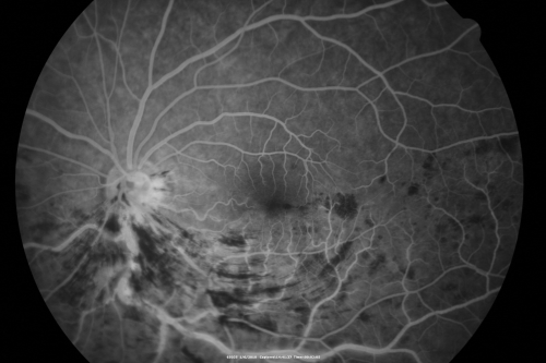 Hemi Central Retinal Vein Occlusion 35 year old non-compliant man
35-year-old man hazy vision in his left eye for about the last three days. OD 20/20,  OS 20/30
