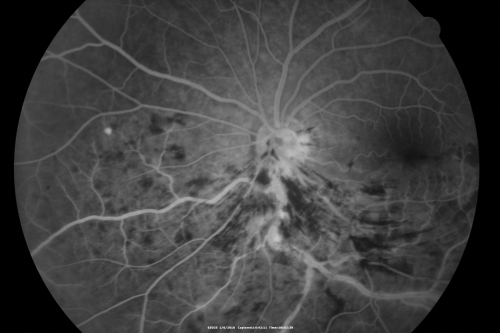Hemi Central Retinal Vein Occlusion 35 year old non-compliant man
35-year-old man hazy vision in his left eye for about the last three days. OD 20/20,  OS 20/30
