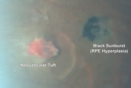 Proliferative Sickle Retinopathy - Hemoglobin SC
53-year-old woman with a new spider-like floater in the right eye for about six days.  She sees one big floater and another little one. She does have hemoglobin SC hemoglobinopathy.  VISUAL ACUITY:  Vision OD is 20/20; OS is 20/50, PH is 20/20. 
