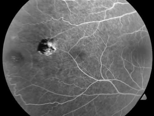 Proliferative Sickle Retinopathy - Hemoglobin SC
53-year-old woman with a new spider-like floater in the right eye for about six days.  She sees one big floater and another little one. She does have hemoglobin SC hemoglobinopathy.  VISUAL ACUITY:  Vision OD is 20/20; OS is 20/50, PH is 20/20. 
