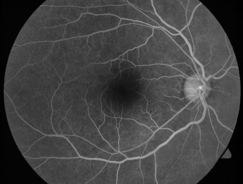 Proliferative Sickle Retinopathy - Hemoglobin SC
53-year-old woman with a new spider-like floater in the right eye for about six days.  She sees one big floater and another little one. She does have hemoglobin SC hemoglobinopathy.  VISUAL ACUITY:  Vision OD is 20/20; OS is 20/50, PH is 20/20. 
