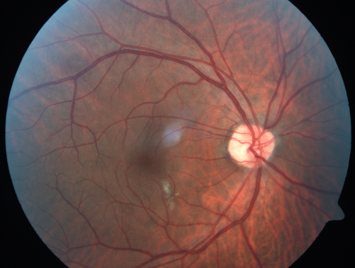 HIV Retinopathy
Central white spot is an artifact.  The small vascular abnormalities are from HIV
