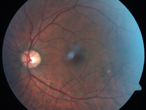 HIV Retinopathy
Central white spot is an artifact.  The small vascular abnormalities are from HIV
