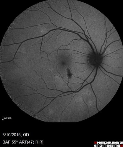 HIV Retinopathy
FAF
