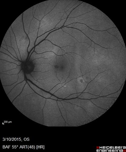 HIV Retinopathy
FAF
