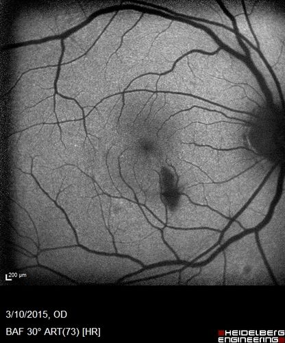 HIV Retinopathy
FAF
