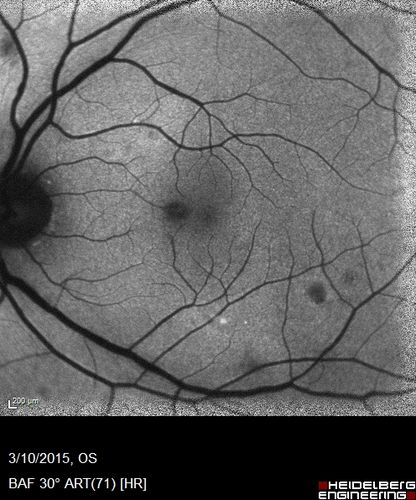 HIV Retinopathy
FAF
