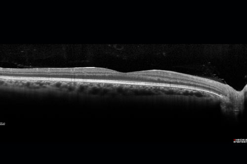 HIV Retinopathy
