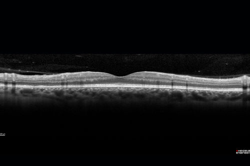 HIV Retinopathy
