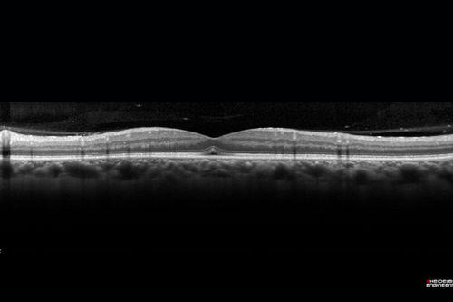 HIV Retinopathy
