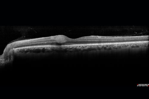 HIV Retinopathy
Retinal edema from microvascular disease
