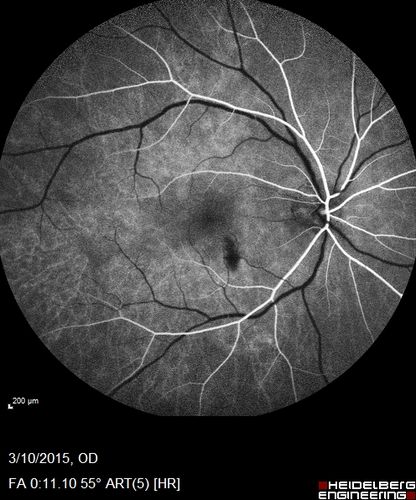 HIV Retinopathy

