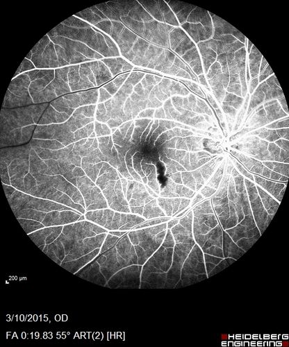 HIV Retinopathy
