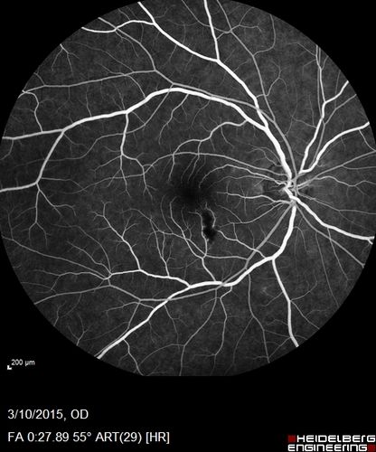 HIV Retinopathy
