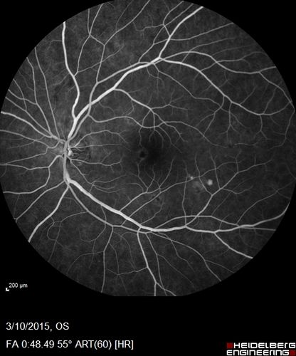 HIV Retinopathy
