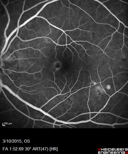 HIV Retinopathy
