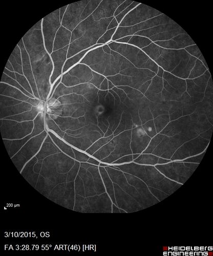 HIV Retinopathy
