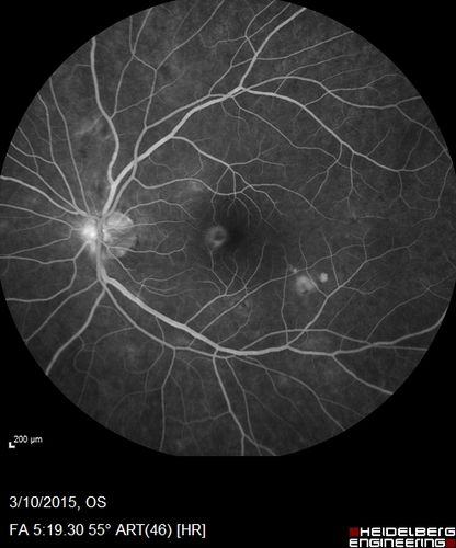 HIV Retinopathy
